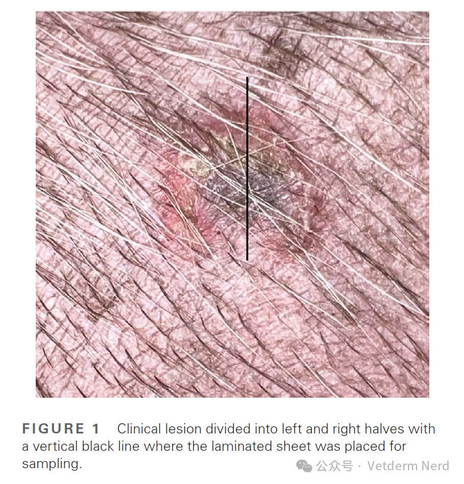 皮肤病学 [原创研究] 浅表细菌性毛囊炎采样：干无菌拭子？还是生理盐水浸泡的无菌拭子？